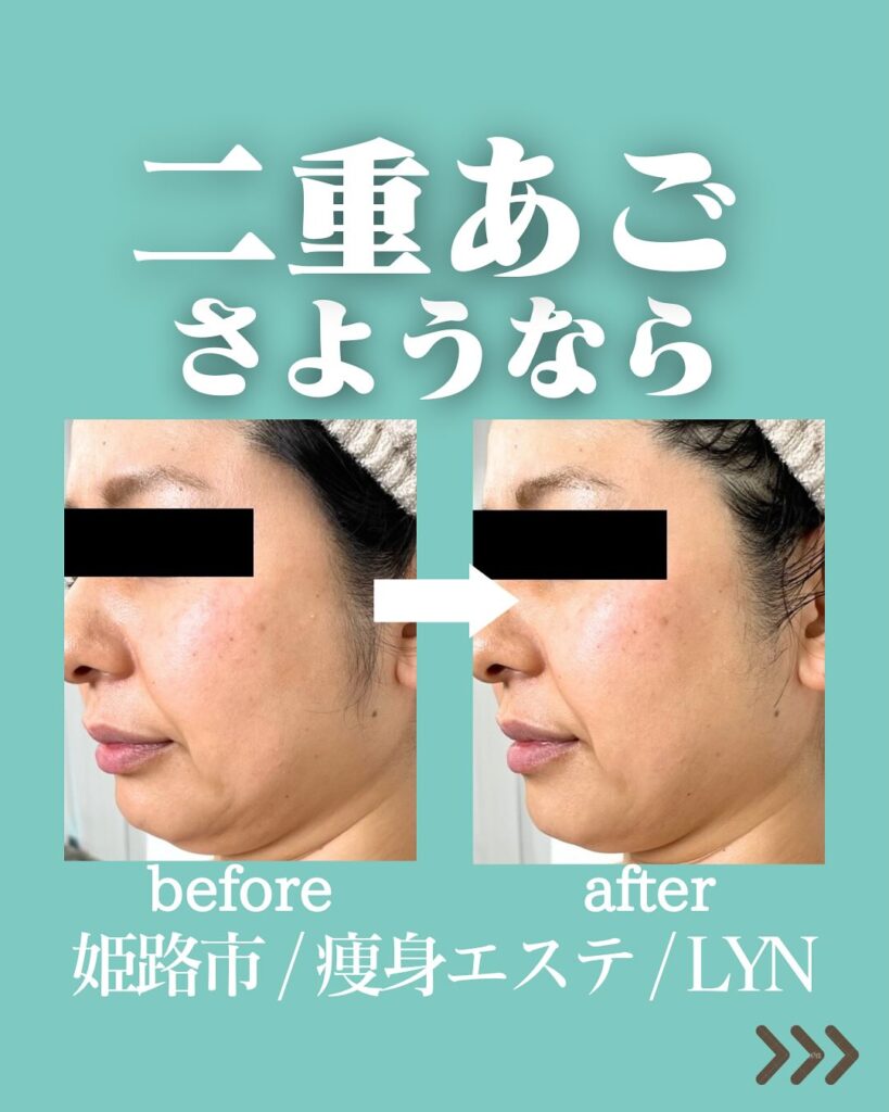 こんばんは！LYN（リン）です♪今回はLYNの痩身エステに通っているお客様のビフォーアフターをご紹介しますあご下のたるみが気になるとお悩みでご来店いただきました！たるみがかなりスッキリしました『２回でこれだけスッキリしたので、次回の施術が楽しみです』と嬉しいコメントをいただきました🥹実はダイエット、ボディメイキングのメニュー同様にフェイシャルのメニューも大人気なんです🥳ぜひフェイシャルメニューも試して下さいね♪他の投稿はコチラから⇒ @lyn_esthe_hifu_datsumou 〒690-0927姫路市駅前町319番地SAIKA駅前319BLD3階